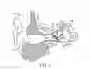 Fig. 03 - Hearing system having improved high frequency response