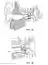 Fig. 04 - Hearing system having improved high frequency response