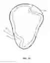 Fig. 11 - Trenched sealing retainer for canal hearing device