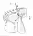 Fig. 13 - DEVICES AND METHODS FOR MINIMALLY INVASIVE ARTHROSCOPIC SURGERY