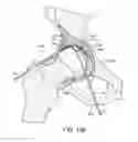 Fig. 18 - DEVICES AND METHODS FOR MINIMALLY INVASIVE ARTHROSCOPIC SURGERY