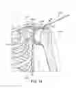 Fig. 23 - DEVICES AND METHODS FOR MINIMALLY INVASIVE ARTHROSCOPIC SURGERY