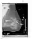 Fig. 01 - Displaying computer-aided detection information with associated breast tomosynthesis image information