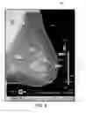 Fig. 06 - Displaying computer-aided detection information with associated breast tomosynthesis image information