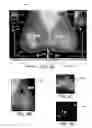 Fig. 09 - Displaying computer-aided detection information with associated breast tomosynthesis image information