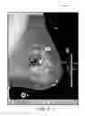 Fig. 10 - Displaying computer-aided detection information with associated breast tomosynthesis image information