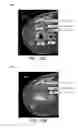 Fig. 11 - Displaying computer-aided detection information with associated breast tomosynthesis image information