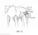 Fig. 13 - Apparatus and method for treating bleeding arising from left atrial appendage