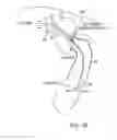 Fig. 17 - Apparatus and method for treating bleeding arising from left atrial appendage