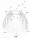 Fig. 12 - Clamping device for reducing venous blood flow