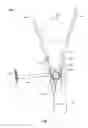 Fig. 06 - Apparatus and methods for bone access and cavity preparation