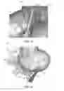 Fig. 08 - Adaptive surface surgical guiding apparatus and systems and methods of manufacturing adaptive surface surgical guiding apparatus