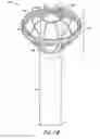 Fig. 03 - VESSEL OCCLUDING MATERIAL EXTRACTOR