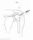 Fig. 02 - Anti-Extravasation Sheath