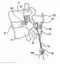 Fig. 01 - Systems and methods for posterior dynamic stabilization of the spine