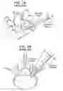 Fig. 02 - Proximal-end securement of a minimally invasive working channel