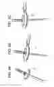 Fig. 07 - Proximal-end securement of a minimally invasive working channel