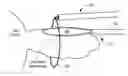 Fig. 01 - Cryoadhesive device for left atrial appendage occlusion