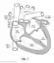 Fig. 02 - Cryoadhesive device for left atrial appendage occlusion