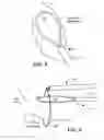 Fig. 07 - Cryoadhesive device for left atrial appendage occlusion