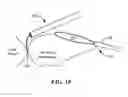 Fig. 08 - Cryoadhesive device for left atrial appendage occlusion