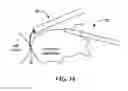 Fig. 13 - Cryoadhesive device for left atrial appendage occlusion