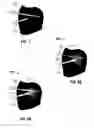 Fig. 08 - HEAT-DISTRIBUTION INDICATORS, THERMAL ZONE INDICATORS, ELECTROSURGICAL SYSTEMS INCLUDING SAME, AND METHODS OF DIRECTING ENERGY TO TISSUE USING SAME
