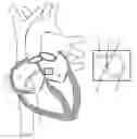 Fig. 01 - Electrosurgical device having a lumen