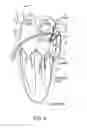 Fig. 08 - Methods and systems for accessing a pericardial space and preventing strokes arising from the left atrial appendage