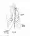 Fig. 10 - Methods and systems for accessing a pericardial space and preventing strokes arising from the left atrial appendage