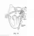 Fig. 17 - Methods and systems for accessing a pericardial space and preventing strokes arising from the left atrial appendage