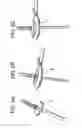 Fig. 07 - Proximal-end securement of a minimally invasive working channel