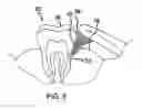 Fig. 05 - Tooth cleaning assembly