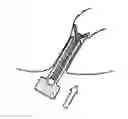 Fig. 01 - Fecal Incontinence Device, System And Method
