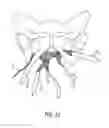 Fig. 08 - Implants and procedures for treatment of pelvic floor disorders