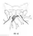 Fig. 11 - Implants and procedures for treatment of pelvic floor disorders