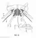 Fig. 13 - Implants and procedures for treatment of pelvic floor disorders