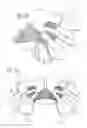 Fig. 14 - Implants and procedures for treatment of pelvic floor disorders