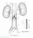 Fig. 02 - Visual stabilizer on anchor legs of vena cava filter