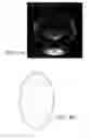 Fig. 03 - Intraocular Lens With Central Hole For Improved Fluid Flow And Minimized Light Scattering
