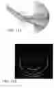 Fig. 10 - Intraocular Lens With Central Hole For Improved Fluid Flow And Minimized Light Scattering