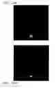 Fig. 24 - Intraocular Lens With Central Hole For Improved Fluid Flow And Minimized Light Scattering