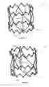 Fig. 14 - Prosthetic heart valve