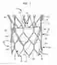 Fig. 02 - Repositioning of prosthetic heart valve and deployment