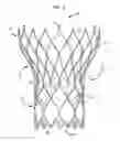 Fig. 03 - Repositioning of prosthetic heart valve and deployment