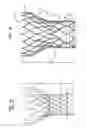 Fig. 05 - Repositioning of prosthetic heart valve and deployment