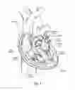 Fig. 02 - DEVICES, SYSTEMS, AND METHODS FOR RESHAPING A HEART VALVE ANNULUS INCLUDING THE USE OF MAGNETIC TOOLS
