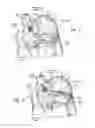 Fig. 12 - DEVICES, SYSTEMS, AND METHODS FOR RESHAPING A HEART VALVE ANNULUS INCLUDING THE USE OF MAGNETIC TOOLS