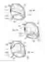Fig. 33 - DEVICES, SYSTEMS, AND METHODS FOR RESHAPING A HEART VALVE ANNULUS INCLUDING THE USE OF MAGNETIC TOOLS