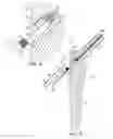 Fig. 07 - Femoral stem and post system for hip prosthesis